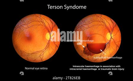 Emorragia intraoculare nella sindrome di Terson, illustrazione Foto Stock