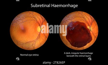 Emorragia subretinica sulla retina, illustrazione Foto Stock