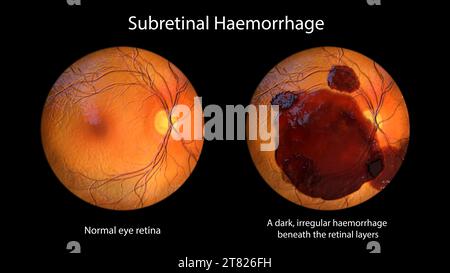 Emorragia subretinica sulla retina, illustrazione Foto Stock