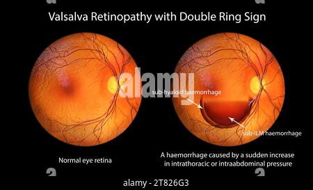 Retinopatia Valsava, illustrazione Foto Stock