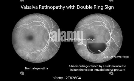 Retinopatia Valsava, illustrazione Foto Stock