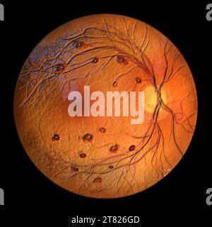 Illustrazione di macchie di Roth nella retina osservate durante l'oftalmoscopia, che mostrano emorragie retiniche centrate in bianco con anelli emorragici circostanti. Foto Stock