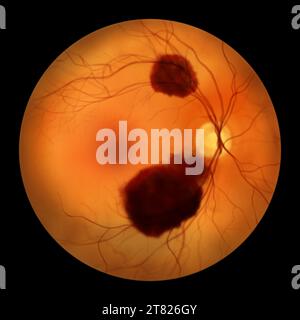 Emorragia subretinica, illustrazione Foto Stock