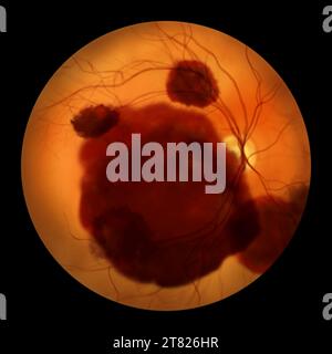 Illustrazione di un'emorragia subretinica osservata durante l'oftalmoscopia, che rivela un'emorragia scura e irregolare sotto gli strati retinici. Foto Stock