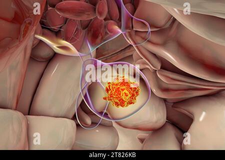 Tumore della ghiandola ipofisaria, illustrazione Foto Stock