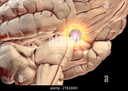 Tumore della ghiandola ipofisaria, illustrazione Foto Stock