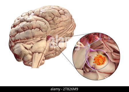 Tumore della ghiandola ipofisaria, illustrazione Foto Stock