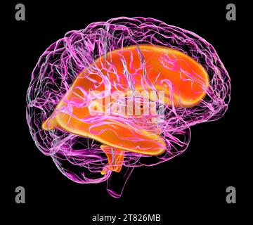 Ventricoli ingranditi del cervello di un bambino, illustrazione Foto Stock