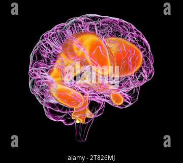 Ventricoli ingranditi del cervello di un bambino, illustrazione Foto Stock