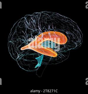 Illustrazione computerizzata che raffigura ventricoli laterali ingranditi (idrocefalo) del cervello. Foto Stock
