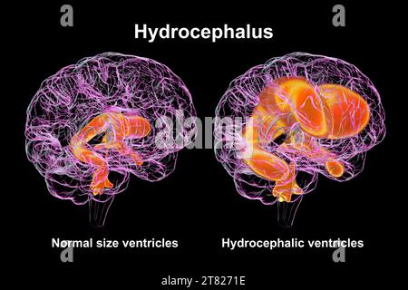 Ventricoli cerebrali ingranditi e normali, illustrazione Foto Stock