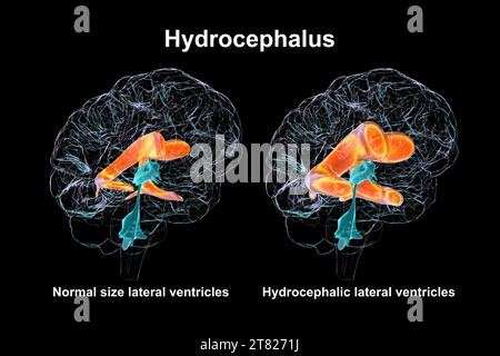 Ventricoli laterali cerebrali ingranditi e normali, illustrazione Foto Stock