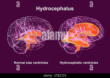 Ventricoli cerebrali ingranditi e normali, illustrazione Foto Stock