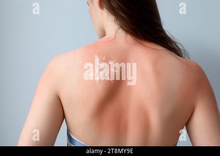 Giovane donna allergica con pelle scottata al sole e crema su sfondo blu, vista posteriore Foto Stock