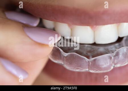 Clear Dental Aligner Aligners: Protezione notturna per allineamento Foto Stock