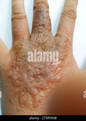 eruzione cutanea eczema dermatite sulla mano. infiammazione della pelle Foto Stock