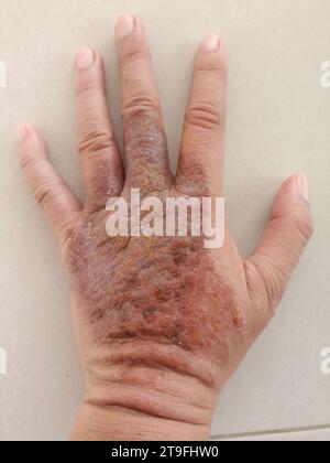 eruzione cutanea eczema dermatite sulla mano. infiammazione della pelle Foto Stock