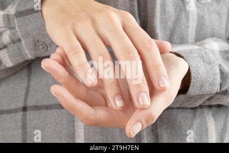 Unghie con onicolisi dopo la rimozione del gel lucido. Mani donne con unghie danneggiate Foto Stock