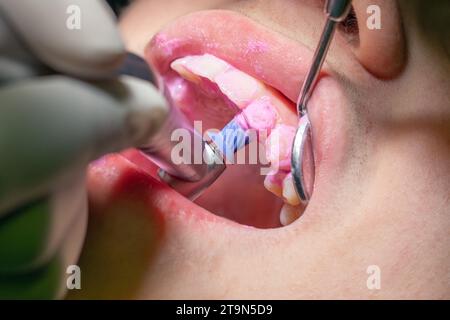 lucidatura professionale dei denti presso il dentista Foto Stock