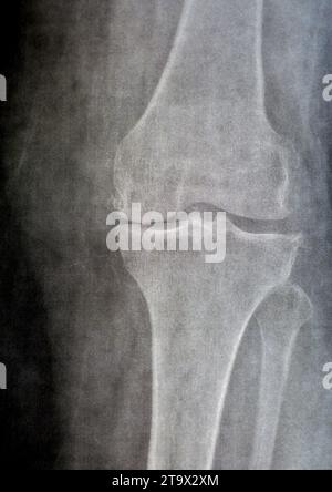 La radiografia semplice del ginocchio sinistro mostra un'apparente osteoartrite articolare secondo il sistema Kellgren e Lawrence per la classificazione dell'osteoartrite con d Foto Stock