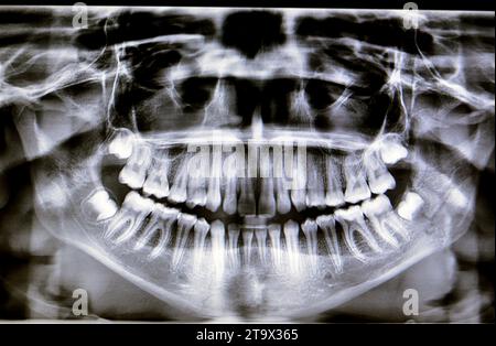 Una radiografia panoramica di una ragazza frattura della mandibola dopo un trauma diretto sul lato sinistro, una scansione panoramica radiografica dentale della parte superiore e lo Foto Stock