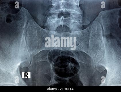 Esame radiografico digitale delle articolazioni sacroiliache la radiografia rivela gli spazi preservati delle articolazioni sacroiliache e le superfici articolari lisce, concetto di dolore lombare, Foto Stock