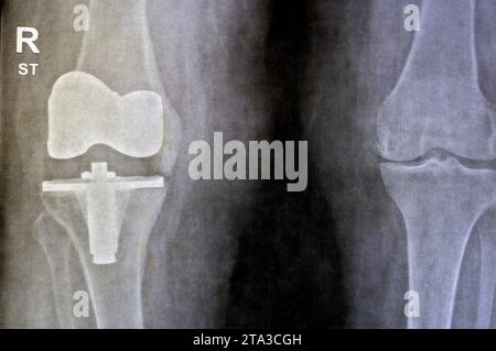 Radiografia semplice delle articolazioni del ginocchio, il lato destro mostra l'artroplastica totale di sostituzione del ginocchio dopo l'osteoartrite articolare di grado 4, una procedura chirurgica per sostituire il t Foto Stock