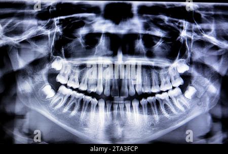 Una radiografia panoramica di una ragazza frattura della mandibola dopo un trauma diretto sul lato sinistro, una scansione panoramica radiografica dentale della parte superiore e lo Foto Stock