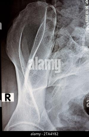 Esame radiografico digitale delle articolazioni sacroiliache la radiografia rivela gli spazi preservati delle articolazioni sacroiliache e le superfici articolari lisce, concetto di dolore lombare, Foto Stock