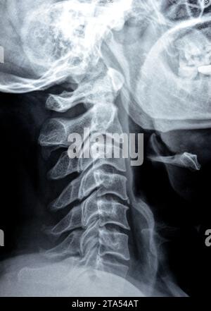 La radiografia semplice della colonna cervicale ha rivelato una curva ...