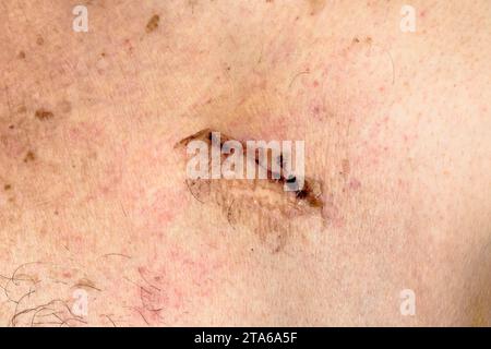 Cicatrice operatoria del pacemaker sul torace di un uomo anziano. 3 settimane. Foto Stock