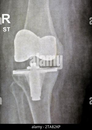 Radiografia semplice che mostra artroplastica di sostituzione del ginocchio destro totale dopo osteoartrite articolare di grado 4, una procedura chirurgica per sostituire i portanti di peso Foto Stock