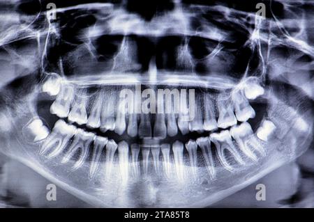 Una radiografia panoramica di una ragazza frattura della mandibola dopo un trauma diretto sul lato sinistro, una scansione panoramica radiografica dentale della parte superiore e lo Foto Stock