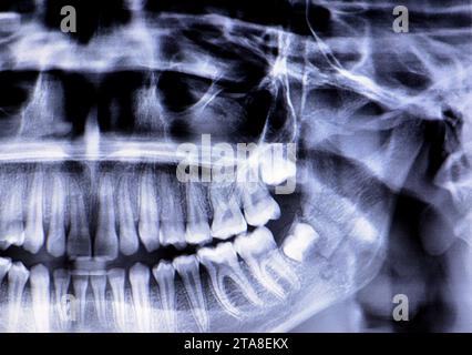 Una radiografia panoramica di una ragazza frattura della mandibola dopo un trauma diretto sul lato sinistro, una scansione panoramica radiografica dentale della parte superiore e lo Foto Stock