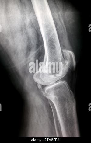 La radiografia semplice del ginocchio sinistro mostra un'apparente osteoartrite articolare secondo il sistema Kellgren e Lawrence per la classificazione dell'osteoartrite con d Foto Stock