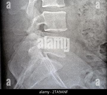 Radiografia liscia della colonna vertebrale lombbosacrale ha rivelato una lieve deformità scoliotica della colonna vertebrale lombare, alterazioni spondilotiche, sacroiliite bilaterale, lieve narr Foto Stock