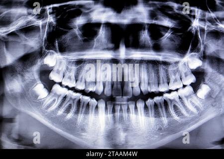 Una radiografia panoramica di una ragazza frattura della mandibola dopo un trauma diretto sul lato sinistro, una scansione panoramica radiografica dentale della parte superiore e lo Foto Stock