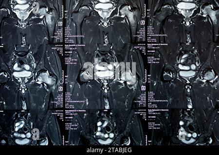 Cairo, Egitto, 21 novembre 2023: RM dell'articolazione dell'anca che mostra necrosi avascolare bilaterale della testa femorale, edema midollare esteso della testa femorale sinistra, del collo, Foto Stock