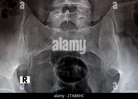 Esame radiografico digitale delle articolazioni sacroiliache la radiografia rivela gli spazi preservati delle articolazioni sacroiliache e le superfici articolari lisce, concetto di dolore lombare, Foto Stock