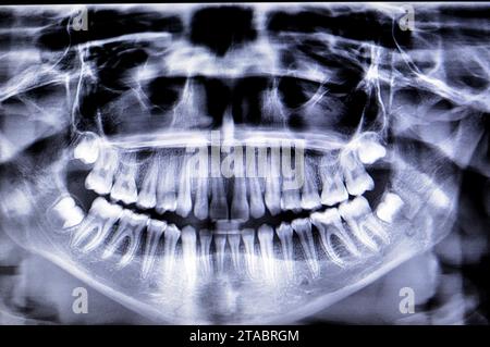 Una radiografia panoramica di una ragazza frattura della mandibola dopo un trauma diretto sul lato sinistro, una scansione panoramica radiografica dentale della parte superiore e lo Foto Stock