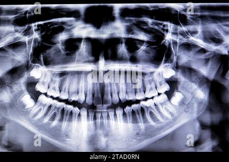 Una radiografia panoramica di una ragazza frattura della mandibola dopo un trauma diretto sul lato sinistro, una scansione panoramica radiografica dentale della parte superiore e lo Foto Stock