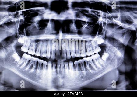 Una radiografia panoramica di una ragazza frattura della mandibola dopo un trauma diretto sul lato sinistro, una scansione panoramica radiografica dentale della parte superiore e lo Foto Stock