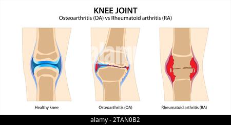 Ginocchio osteoartrite articolare vs artrite reumatoide Foto Stock