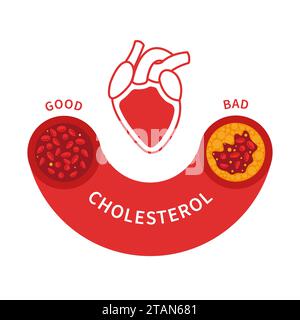 Livelli di colesterolo, illustrazione concettuale. Foto Stock