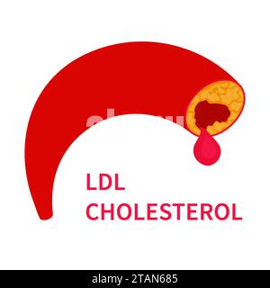 Colesterolo LDL, illustrazione concettuale Foto Stock