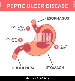 Ulcera peptica, illustrazione concettuale Foto Stock