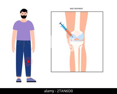 Iniezione per dolore al ginocchio, illustrazione Foto Stock