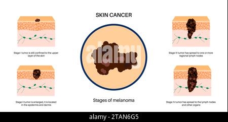 Stadi del melanoma, illustrazione Foto Stock