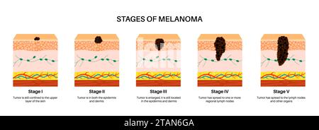 Stadi del melanoma, illustrazione. Foto Stock