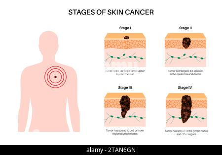 Stadi del melanoma, illustrazione. Foto Stock